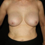 Breast Augmentation - Case #1 After